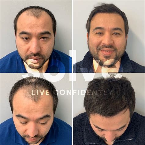 Solve clinics - Solve Clinics Patient. 6 months into the procedure now I couldn’t be happier with my results. Solve does a great job making the entire hair restoration process seamless. From the amazing staff to excellent customer service this is the place to go for all your hair restoration needs.